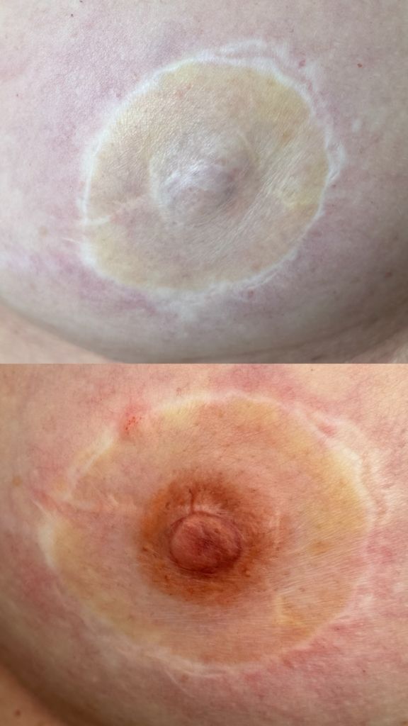 Areola Mamillenrekonstruktion Permanent Make-up Frankfurt